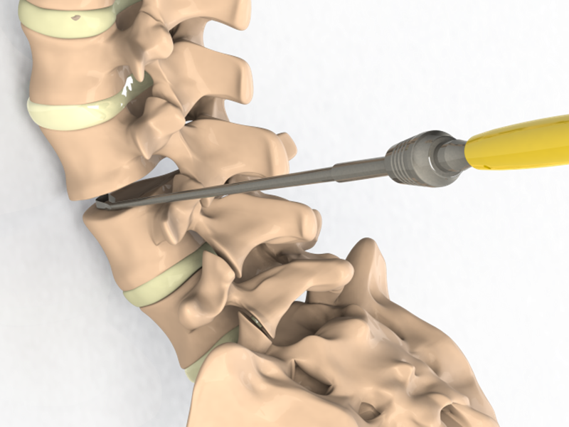 Biomech Transforaminal Lumbar Interbody Fusion Peek Cage Tlif